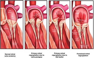 Percutaneous Mitral Valve Interventions (Repair): Current Indications and Future Perspectives